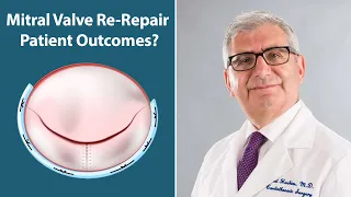 Mitral Valve Re-Repair Outcomes with Dr. Sabet Hashim