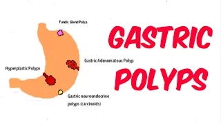 Gastric (Stomach) Polyps!