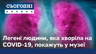 Легені людини, яка хворіла на коронавірус, виставили у музеї хвороб у Львові