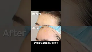 이마필러 전 후, 입체적인 이마 #shorts #쇼츠