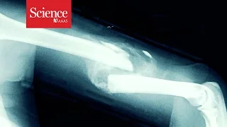 Tiny bubbles help heal broken bones