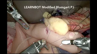 Robotic Surgery - Modified Blumgart Pancreaticojejunostomy