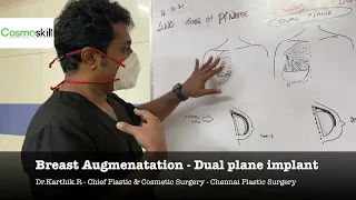 Illustration : Dual Plane Breast Augmentation