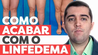 O que é linfedema e seu efeito na circulação? Precisa operar, desentupir as veias? Causa erisipela?