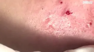 03 Huge Acne Pimples Blackheads Popping Up Satisfying with Oddly Calm Music Part Two