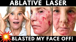 SMOOTHER, YOUNGER LOOKING SKIN |My Ablative Laser Resurfacing Treatment & Recovery (Before/Afters)