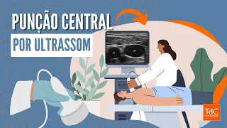 PUNÇÃO CENTRAL POR ULTRASSOM