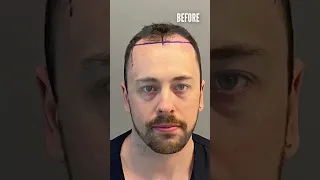 Hair Transplant Before and After of Matthew! 6 MONTHS / 5000 Grafts