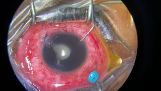 Vitreous lavage for traumatic Endophthalmitis for a 5-year- old boy.