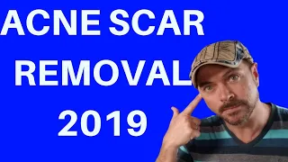 ACNE SCAR REMOVAL 2019