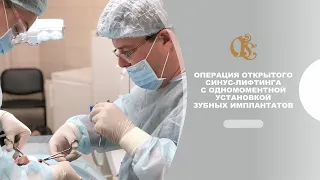 Операция открытого синус-лифтинга с одномоментной установкой зубных имплантатов.