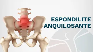 Espondilite Anquilosante