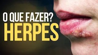 HERPES LABIAL? Bolhinhas ESTRANHAS na boca! O QUE FAZER E O TRATAMENTO COMPLETO #herpes