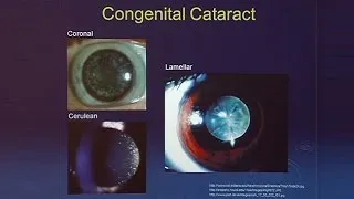 Cataracts: A Surgical Revolution