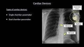 How to Interpret a Chest X-Ray (Lesson 9 - Atelectasis, Lines, Tubes, Devices, and Surgeries)