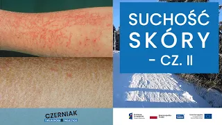 Suchość skóry - cz. 2 - Dr hab. n med. Danuta Nowicka -specjalista dermatolog-wenerolog