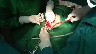 Low segment Cesarean section