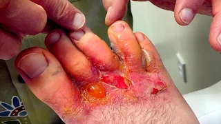 HORRIBLE FOOT RASH! (Infection?) | Dr. Paul