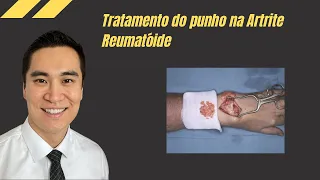 Tratamento do punho na Artrite Reumatóide