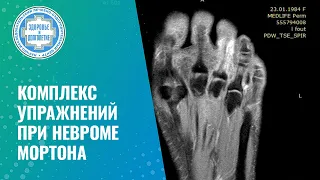 📌🦶 Комплекс упражнений при невроме Мортона