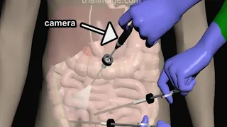 Laparoscopic Appendectomy - Animation by Cal Shipley, M.D.