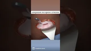 Кесарево сечение анимация