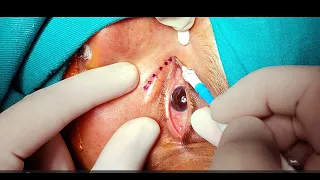 External DCR (Dacryocystorhinostomy)- Lacrimal Intubation