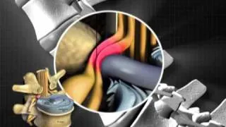 Ozone Discectomy for Slipped Disc_Part3.mp4