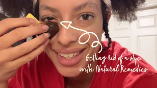 HOW TO: Get Rid of a Stye FAST l 3 - 4 Days with Natural Remedies