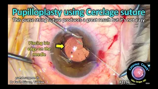 CataractCoach™ 2196: pupilloplasty using cerclage suture (purse string)