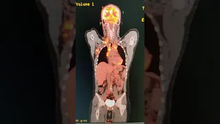 Conhecendo um pouco sobre a imagem de PET-CT