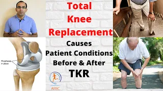 Total Knee Replacement | Causes of Knee Replacement | Patients Before And After TKR | Urdu and Hindi