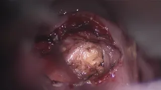 Asvide: Transoral excision of Zenker's diverticulum