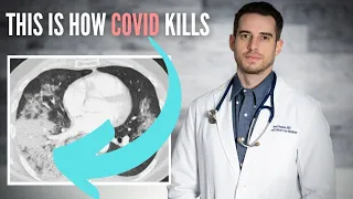 How COVID Kills Some People But Not Others - Doctor Explaining COVID