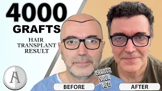 Successful FUE Hair Transplantation | 4000 GRAFTS | Trasplante Capilar FUE Exitoso | 4000 FOLÍCULOS