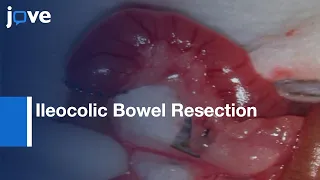 Ileocolic Bowel Resection with Primary Anastomosis | Protocol Preview