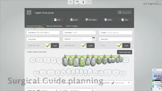 Digital planning for guided surgery