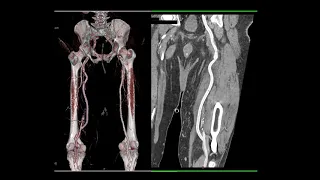 CT of Abdominal Aorta: Aneurysms, Dissections and Repair Part 1