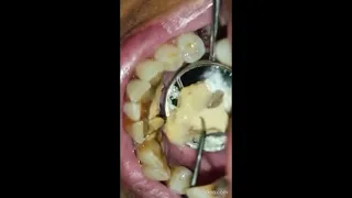 удаления зубного камня смотреть на ютуб _tartar removal watch on youtube