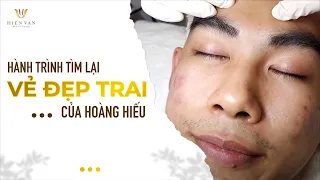 Super cyst was extracted carefully at hien van spa-427-Hoàng Hiếu