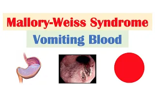 Mallory Weiss Syndrome (Tear) | Risk Factors, Causes, Signs & Symptoms, Diagnosis, Treatment