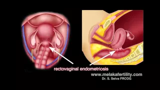 Laparoscopic surgery for endometriosis