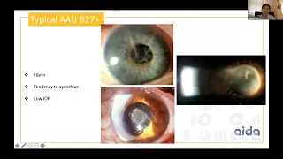 Uveitis Webinar - 20 (Uvea Rheumatology Interface)