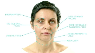 Silhouette Soft Thread Lift: Future of Non-Surgical Skin Lifting Treatment