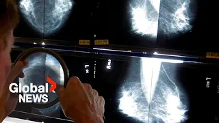 Calls grow to lower recommended age for mammograms