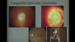 Suspicious Optic Nerve Heads and Glaucoma