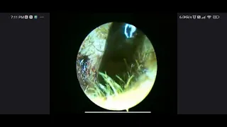 BLOOD CLOT REMOVAL FROM EAR CANAL