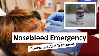 Nosebleed Emergency and Tranexamic Acid Treatment