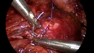 Laparoscopic Pyeloplasty 4K تجميل وإصلاح ضيق حوض الكلية بواسطة منظار البطن د.حيدر العارضي