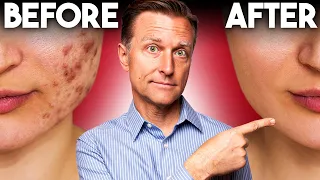 The FASTEST Way to Rid Acne - Dr. Berg